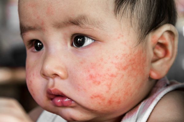 Trẻ bị nổi mẩn đỏ trên mặt là bệnh gì?